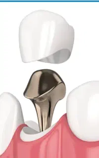 پست و کور و روکش با کمترین قیمت