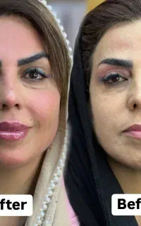تخفیفات رایگان فیلر و بوتاکس در کلینیک سوین