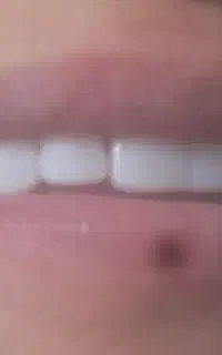 کامپوزیت دندان/اصلاح طرح لبخند/ترمیم لب‌پرشدگی‌