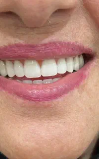 ساخت دندان مصنوعی با کیفیت عالی