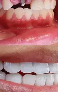 مژده .ایمپلنت. کره ای. دندان باقیمت 11میلیون