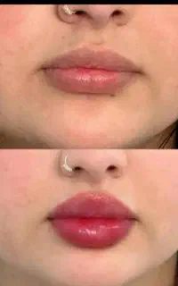 فیلرو ژل لب ، بوتاکس ، فیلر بادی