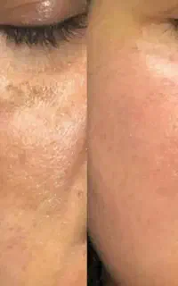 پماد اورجینال بیوممتیک شارژ شد
