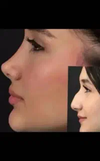 جشنواره جراحی بینی