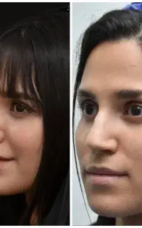تخفیف ۵۰ درصدی عمل بینی