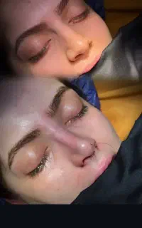 جراحی زیبایی بینی توسط متخصص ENT