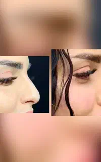 زیبایی نیلگون تخفیف میکروبلیدینگ،فیبروز،فیلر(ژل)