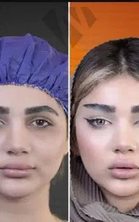 مرکزتخصصی لیفت شقیقه بلفاروپلاستی مطب فوق تخصص
