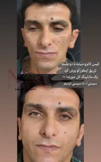 تزریق بوتاکس ژل و ..