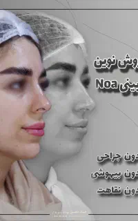 فرمدهی بینی Noa بدون عملDrپوست مو ابرو غبغب زیبایی