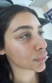 آموزش تخصصی  ژل ، بوتاکس ، جوانسازها ، و آنزیم