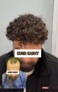 کاشت مو و ابرو در کامیاران