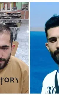 کاشت مو فقط ۵ میلیون