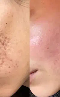میکرونیدلینگ/مزونیدلینگ تخصصی صورت در قم