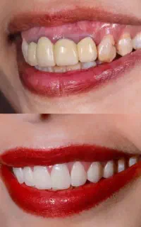 دندان پزشکی اوردنچر دوفک (اقساطی)