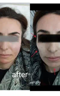 تزریق ژل بوتاکس