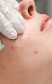 انجام PRP ، مزوتراپی و میکرونیدلینگ در کلینیک