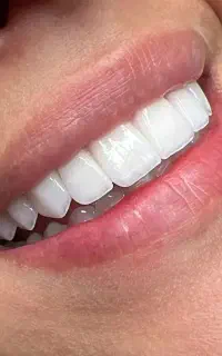 جشنواره دندانپزشکی کامپوزیت دندان عصبکشی و روکش