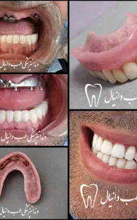 دندان مصنوعی،روکش،ایمپلنت دندانپزشکی دکتر نقوی
