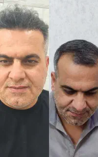 کاشت مو طبیعی به روش sut