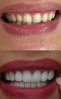 تخفیف ویژه کامپوزیت
