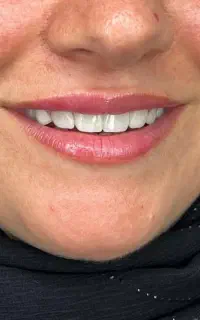 ایمپلنت اقساطی لردگان
