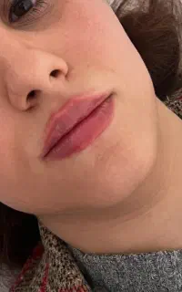 جشنواره تخفیفی بهاره فیلر بیکینی بوتاکس لیزر