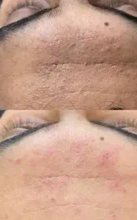 پاک سازی مردانه، پایان لک و جوش های سرسیاه