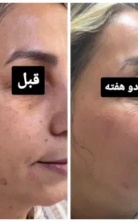 درمان لک جای جوش منافذ باز