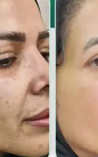 مزوتراپی و میکروندلینگ موو پوست ضد لک و منافذ باز