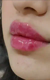 تزریقات ژل و بوتاکس