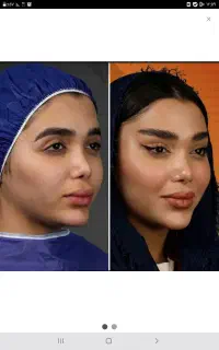 لاغری و پیکر تراشی/لیفت ابرو وشقیقه +اقساطی