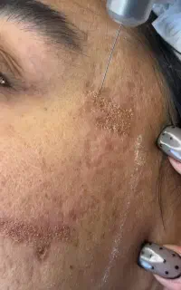 لیزر رفع لک جای جوش منافظ باز رفع چروک