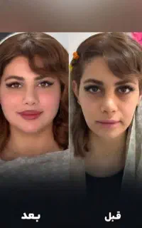 تخفیف ویژه اموزش وتزریق ژل و چربی صورت