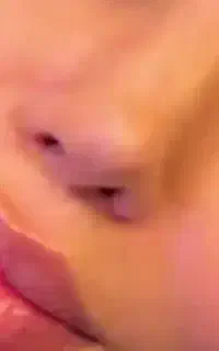 تزریق ژل و بوتاکس