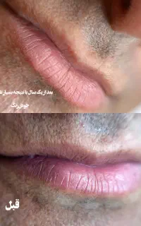 مرکز تخصصی رفع تیرگی لب و آرایش دائم