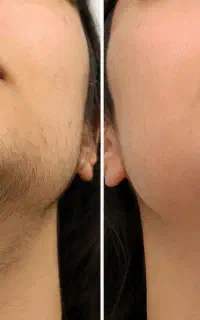 لیزر فول بادی با تخفیف