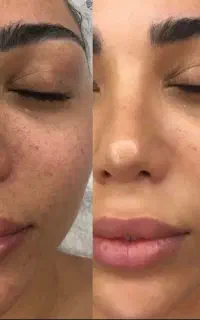 تخفیف بهاره پاکسازی تخصصی و فیشال صورت