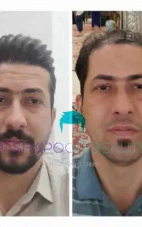 کاشت مو