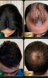 رفع طاسی سر و کم پشتی مو