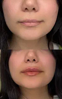 فیلر بوتاکس تمام خدمات زیبایی در کلینیک نویا