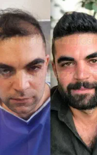 معجزه کاشت مو دکتر شیراز در شهر تبریز