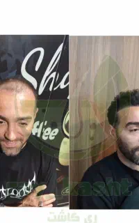 کاشت ابرو ، مو و ریش ( ضمانت نامه کتبی )