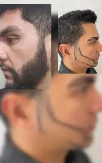 کاشت مو دکترسسلیمی
