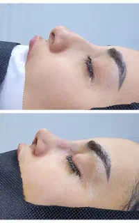 عمل بینی فقط ۴۵ تومان بدون هزینه اضافی
