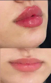 (ژل و بوتاکس