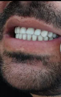 ساخت دندان مصنوعی