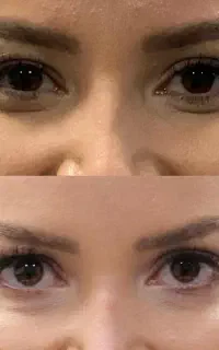 جشنواره ویژه تابستانه تزریق بوتاکس ویژه بانوان