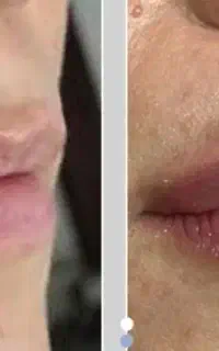 فیلر بوتاکس
