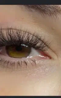 کاشت هیدن فقط هزینه مواد و مدل رایگان